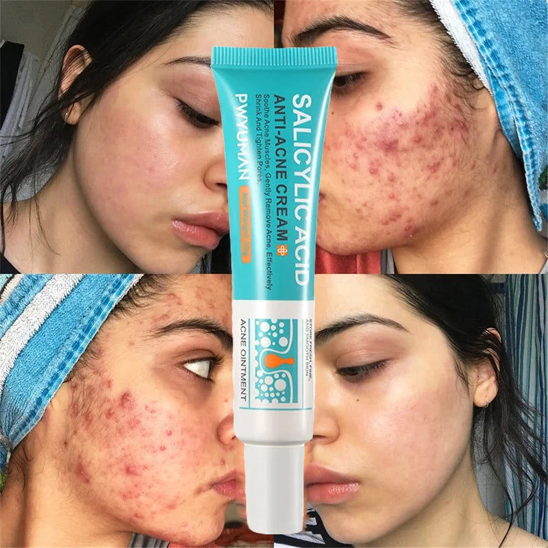 Salicylic Acid Acne Repair Cream – Deep Cleansing, Pore Refining & Redness Repair 🔥 BUY 2 GET 1 FREE 🔥 - (Pack of 3)